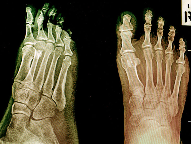 ARTHRITIC-FEET-biomedcode