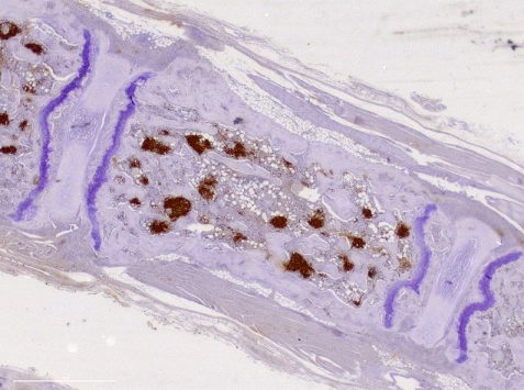 B cells aggregates in BM immunohistochemistry