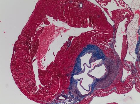 Heart valve thickening Masson’s staining