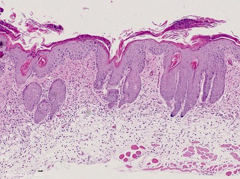 Psoriatic skin H&E staining